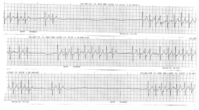 Sick sinus syndrome