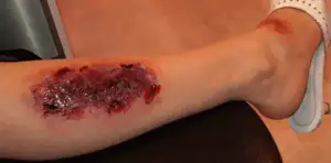 3rd degree burn with latex