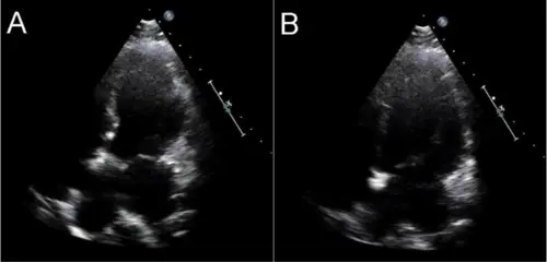 Cardiac ultrasound