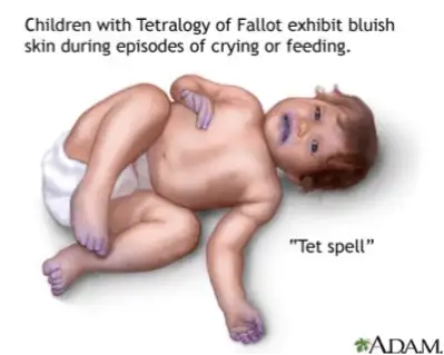 baby with tetralogy fo fallot and bluish lips symptoms