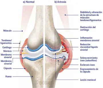 comparison of normal and arthritic knee joints