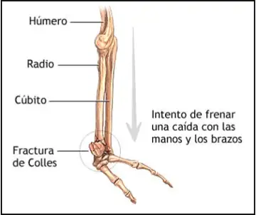 drawing of a colles fracture