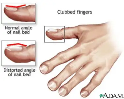 drawing of clubbed fingers