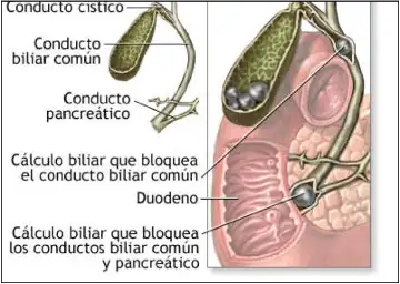 drawing of gallbladder with stones