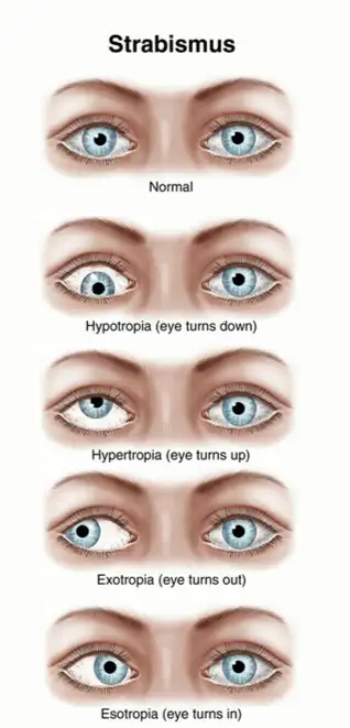 drawing of strabissimus example