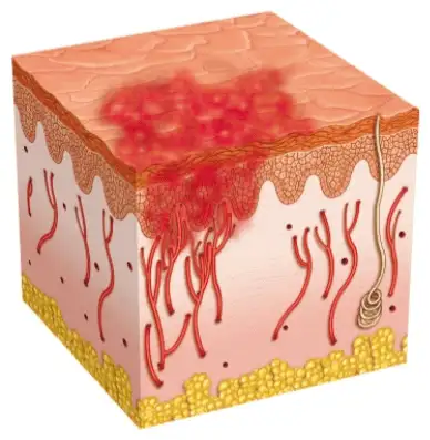 epidermis with red spot