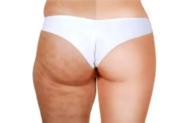 example of cellulite caused dimples on legs