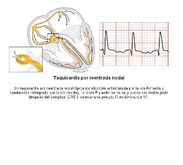 nodal re-entrant tachycardia
