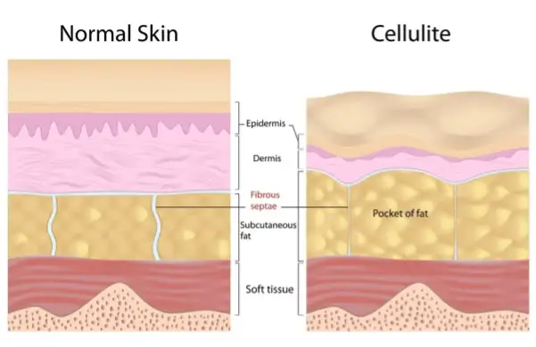 normal skin versus cellulite
