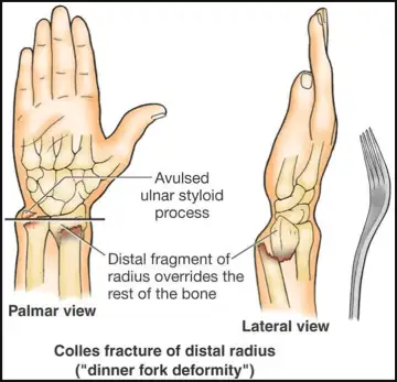 palmar view and lateral view of fracture at wrist