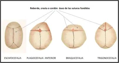 sutures and anomalies of the skull