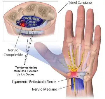 wrist with carpal tunnel syndrome