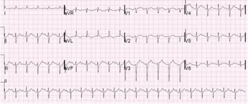 Initial ECG