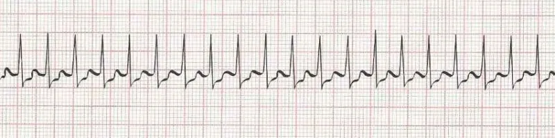 Supraventricular Tachycardia (SVT)  Narrow complex tachycardia
