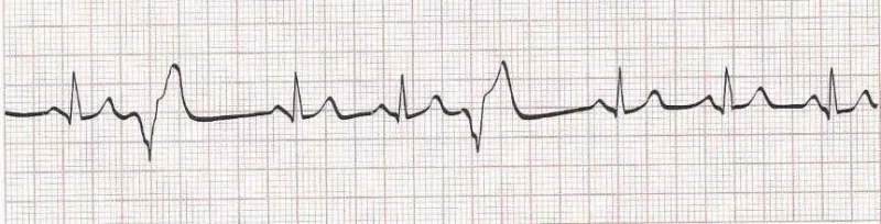 Sinus rhythm with PVCs