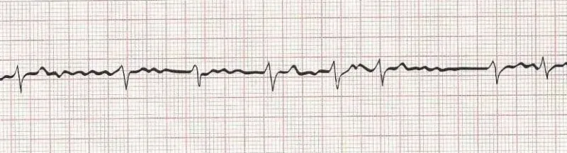 Atrial fibrillation (irregular rhythm without discernible P waves)