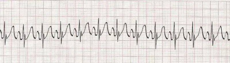 Sinus tachycardia - heart rate greater than 100