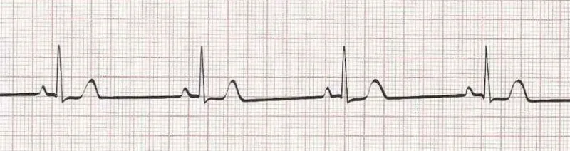 Sinus bradycardia - heart rate 40