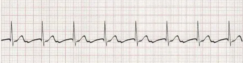 Sinus rhythm with 1st degree AV block (PR -.30 seconds)