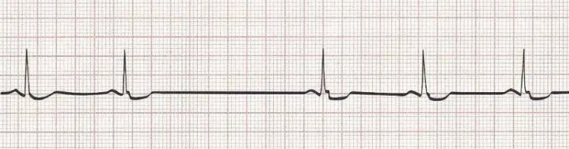 Sinus bradycardia with a sinus pause