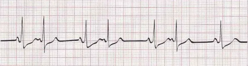 Sinus rhythm with atrial bigeminy (PAC every other beat)