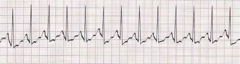 Sinus tachycardia - heart rate greater than 100