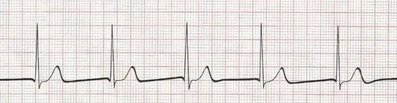 Junctional rhythm