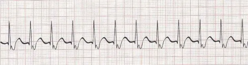 Junctional tachycardia
