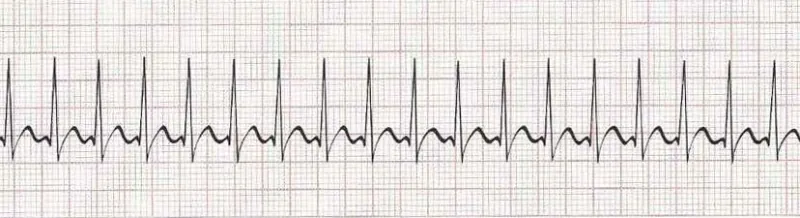 Sinus tachycardia - heart rate greater than 100
