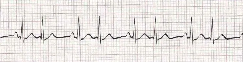 Sinus rhythm with atrial bigeminy (PAC every other beat)