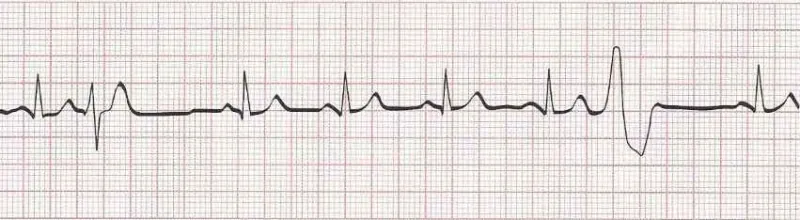 Sinus rhythm with PVCs