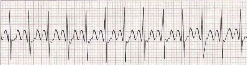 Atrial flutter (advanced atrial tachycardia with block)