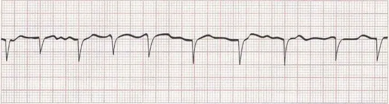 Atrial fibrillation