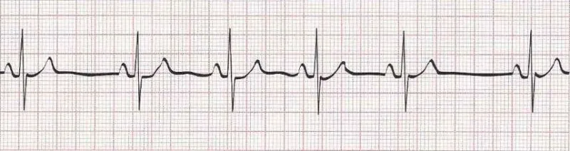 Sinus arrhythmia
