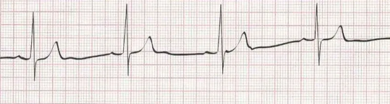 Sinus Bradycardia (heart rate less than 60)