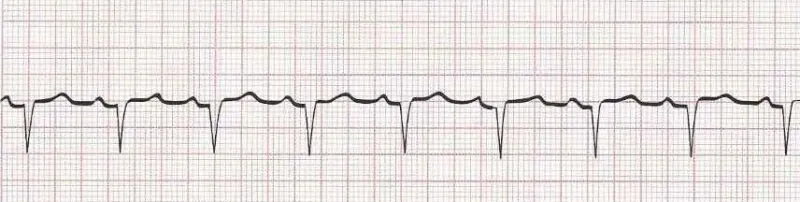 Sinus rhythm