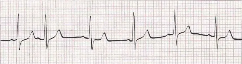 Sinus rhythm with PACs
