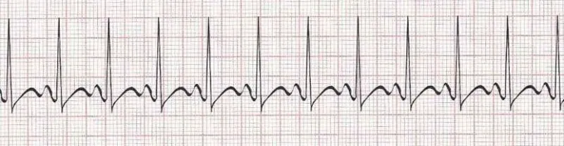 Sinus tachycardia - heart rate greater than 100
