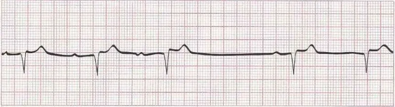 Mobitz I heart block (the last beat is actually a junctional beat)