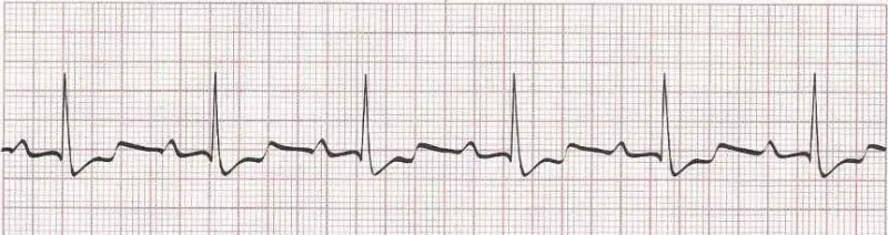 Sinus rhythm with a 1st degree AV Block