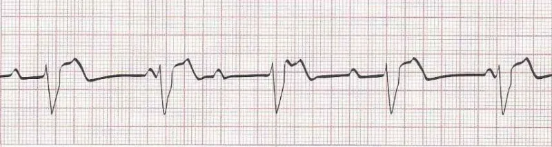 3rd degree heart block (complete heart block)