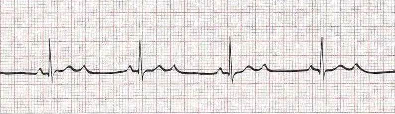2nd degree AV block mobitz II (2 or more P waves for every QRS)