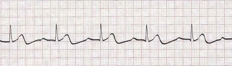 Sinus rhythm with 1st degree AV block