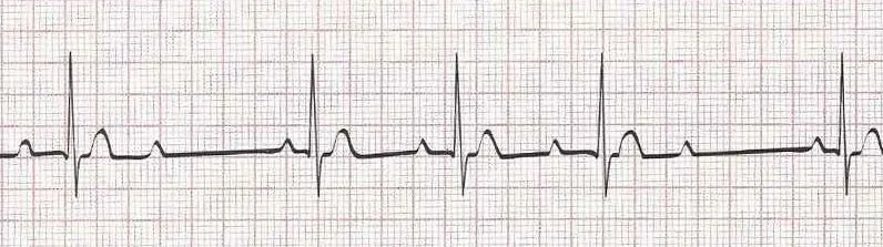 2nd degree AV block mobitz type I (wenckebach) PR longer, longer, dropped QRS