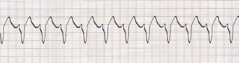 Sinus rhythm (could be tunctional tachycardia). Hard to see P waves