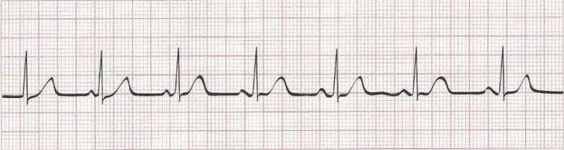Wandering atrial pacemaker