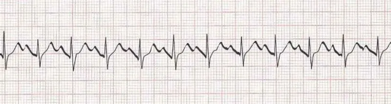 Sinus tachycardia - heart rate greater than 100