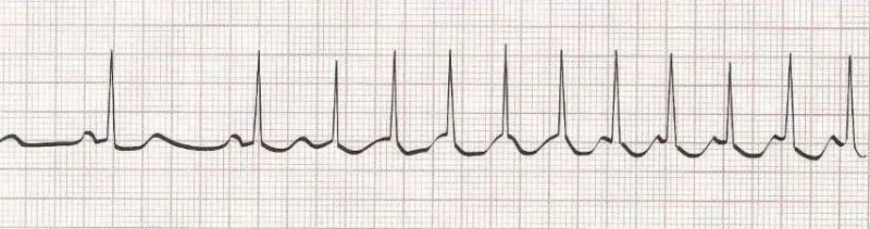 Sinus rhythm changing into SVT