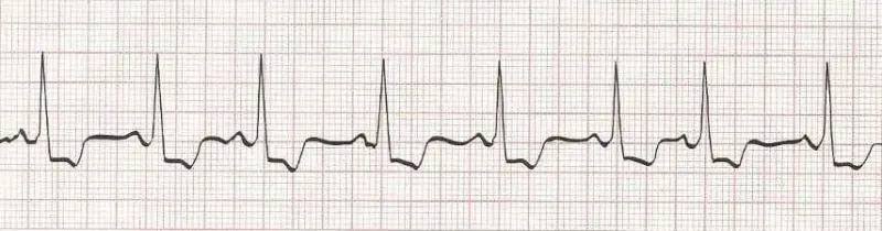 Sinus rhythm with a PAC