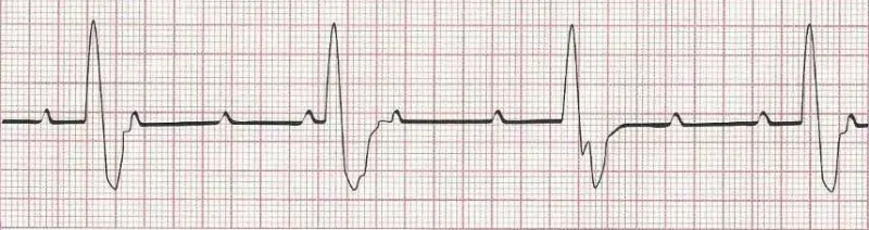 Complete heart block (3rd degree heart block) with ventricular (wide) response